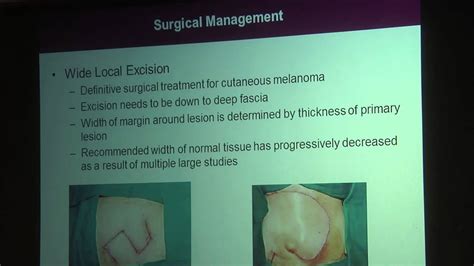 Melanoma Surgical Considerations And Staging Youtube