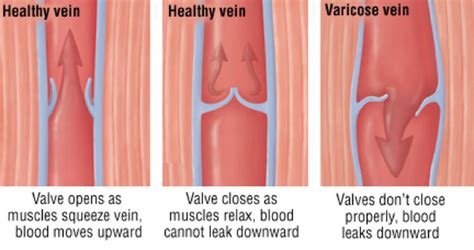 Varicose Veins And Leg Swelling Cardiovascular Health Clinic