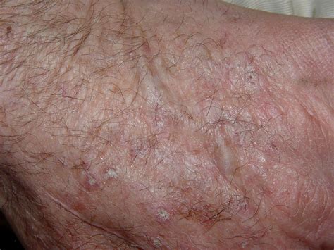 Actinic Keratosis Picture Medical Pictures Info Health Definitions