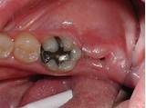 Treatment For Dry Socket After Tooth Removal Photos