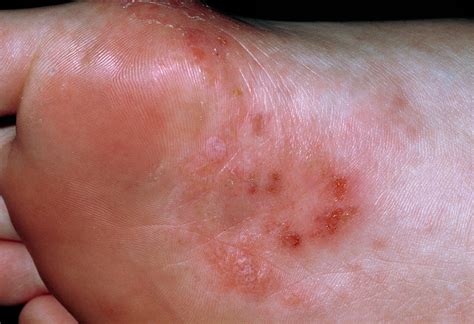 The Sole Of A Foot Affected By Pompholyx Eczema Photograph By Dr P