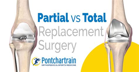 Partial Vs Full Knee Replacement Pontchartrain Orthopedics