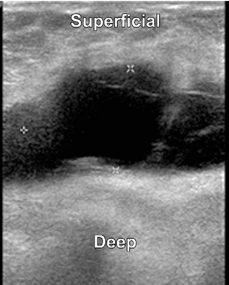 Figure 1 From Chyle Leak After Axillary Lymph Node Dissection