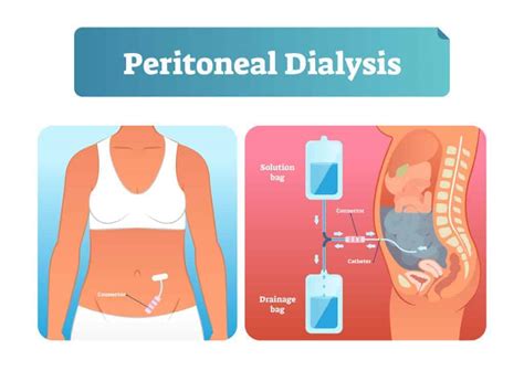 The Definitive Guide To Dialysis Types Of Dialysis Indications Side