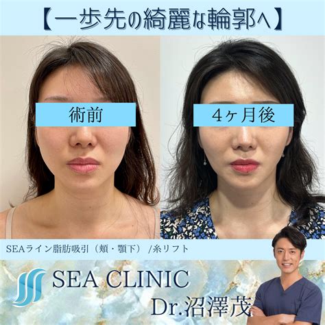3d脂肪吸引×糸リフトで自信をつける Sea Clinic −シークリニック 銀座― 理想を叶える小顔治療