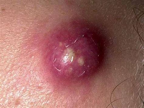 Folliculitis And Skin Abscesses Skin Disorders