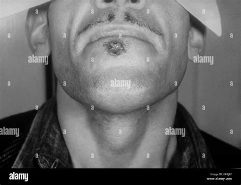 Syphilis Chancre Hi Res Stock Photography And Images Alamy