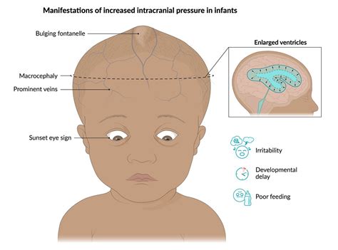 Hydrocephalus Baby Signs