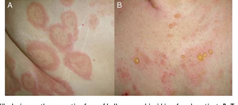 Figure 1 From Bullous Pemphigoid Clinical Practice Guidelines