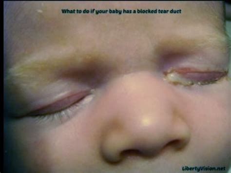 How To Cure Your Babys Blocked Tear Duct Musely