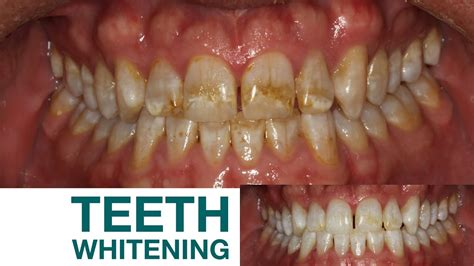 Bright White Smile Teeth Whitening Before And After Chicago