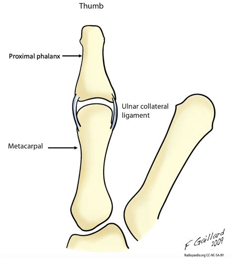 Ulnar Collateral Ligament UCL Injury Of Thumb The Lothian Hand Unit