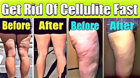 how to get rid of cellulite on thighs treatments and remedies for cellulite get rid of