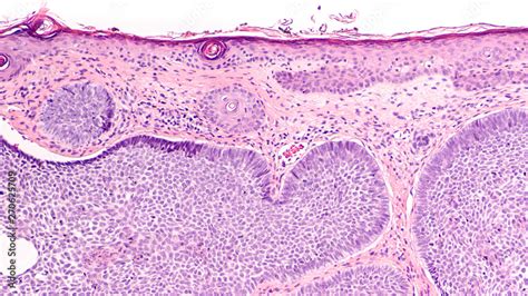 Fototapeta Skin Biopsy Pathology Of Basal Cell Carcinoma The Most Most