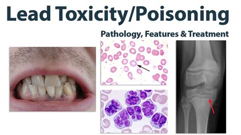 Lead Poisoning Or Toxicity Pathophysiology Features And Treatment
