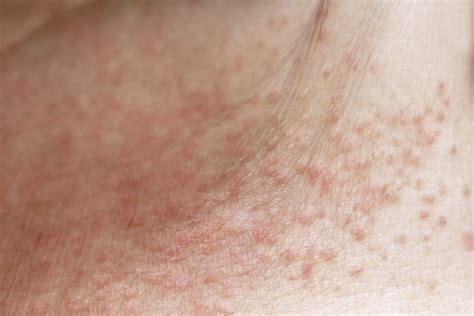 Dermatite Da Sudore Quanto Dura Eritema E Irratazione My Xxx Hot Girl