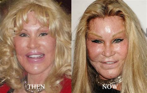 Plastic Surgery Stars Before And After Top Hollywood Plastic
