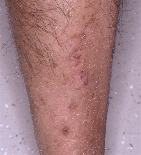 Diabetic dermopathy (Pigmented pretibial patches of ...