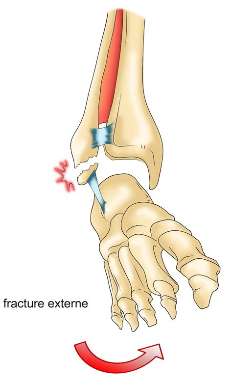 La cheville située entre la jambe et le pied, comprend l'extrémité inférieure du tibia, l'extrémité inférieure de la fibula les différentes pièces osseuses sont reliées par des ligaments. Blog 75: Infos santé : Sport et Santé-Entorse de la cheville