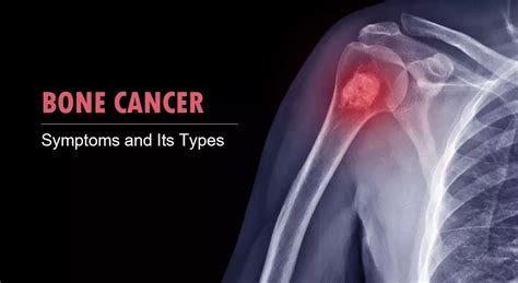 Bone Cancer Symptoms And Types