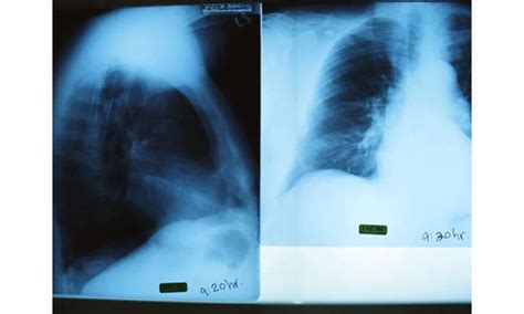 Chest X Ray Findings Normal For Many Confirmed Covid 19 Cases