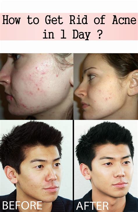 Natural Skin Healing How To Get Rid Of Acne In 1 Day