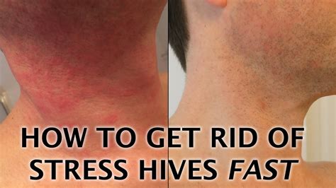 Can Stress Anxiety Cause Hives