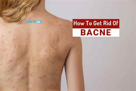 How To Get Rid Of Bacne 5 Natural Ways To Treat Back Acne