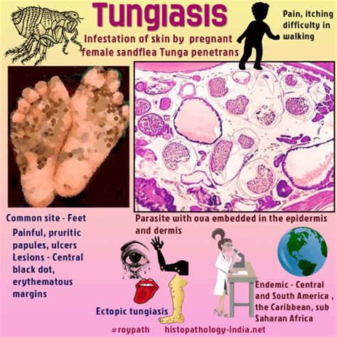 Pathology Of Tungiasis A Neglected Parasitic Disease 10 Important