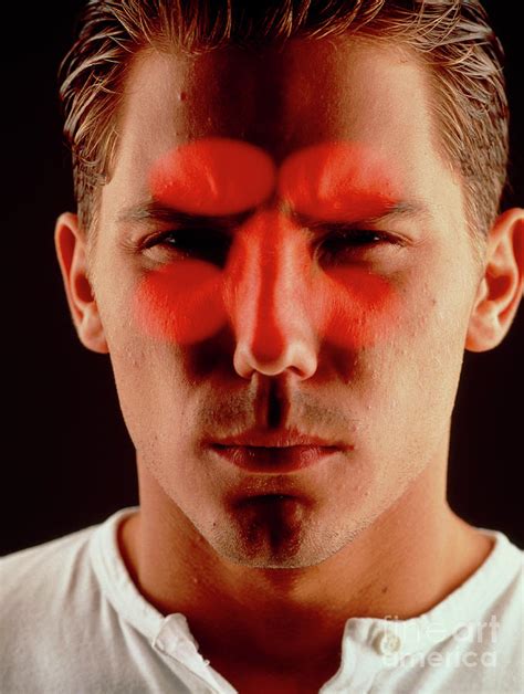 Sinusitis Male Face With Red Sinuses Highlighted Photograph By Oscar