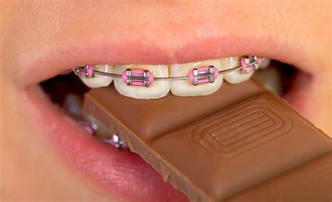 5 Foods To Avoid When You Are Wearing Braces