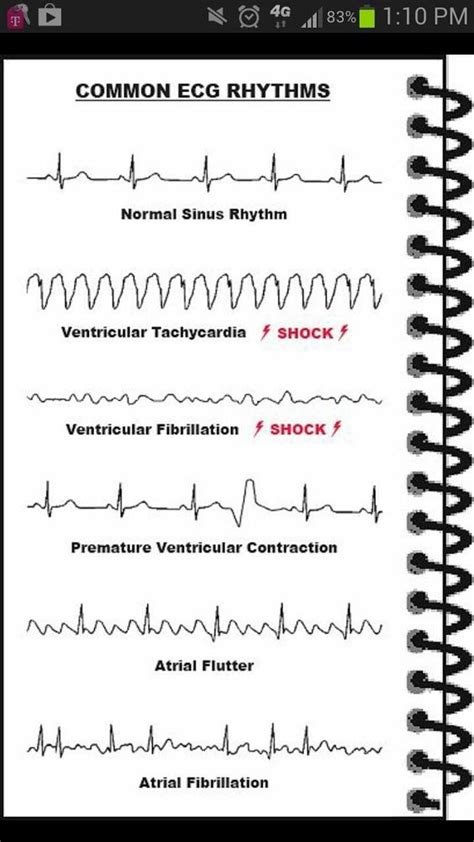 Ecgs Abnormal And Normal Heart Rate Nursing Nursing Pinterest