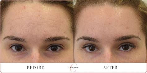 Anti Wrinkle Injections Before After Cosmos Aesthetics