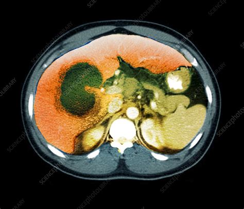 Liver Abscess Ct Scan Stock Image C0267956 Science Photo Library