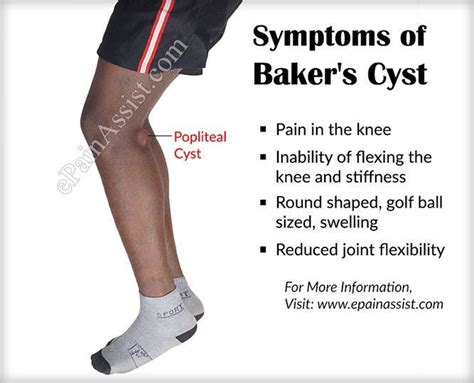 Bakers Cyst Or Popliteal Cystcausessymptomstreatmentexercisehome