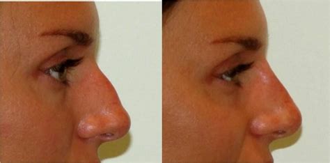 Before And After Non Surgical Nose Job With Filler Eastern European