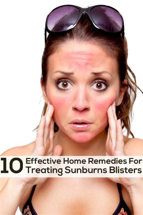 Top 10 Effective Home Remedies For Treating Sunburn Blisters