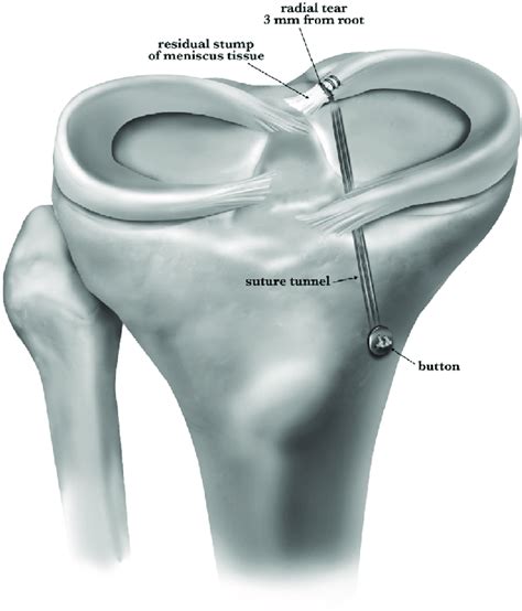 Transtibial Pullout Repair Of Posteromedial Meniscal Root Tear Download Scientific Diagram