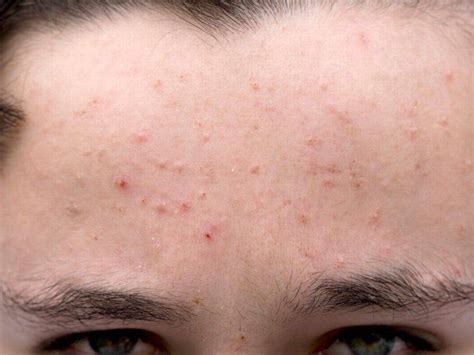 Main Forehead Of A Teenage Boy With Pimples And Scratch Marks 2204