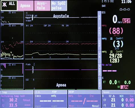 Open Heart Surgery Vital Signs Photograph By Antonia Reevescience