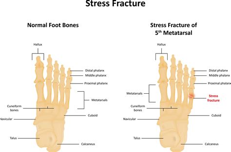 Stress Fractures Highgate Podiatry Biomechanics Orthotic Insoles
