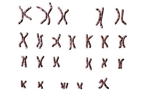 The diagnosis must be confirmed by a chromosome study (karyotype). Down's Syndrome Karyotype Photograph by Kateryna Kon/science Photo Library