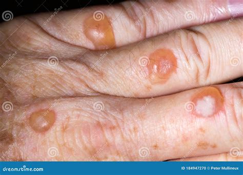 Blisters From Cryotherapy Treatment For Solar Keratosis Stock Photo