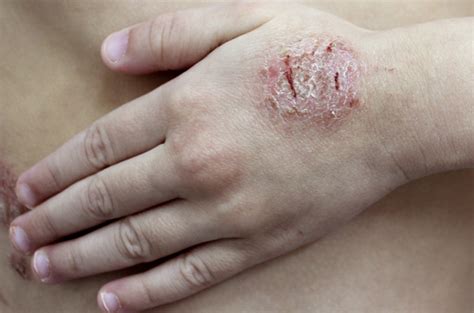 6 Tipos De Eczema Causas Sintomas E Tratamento Mdsaúde 2022