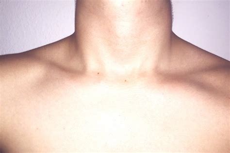 Got Dark Marks On Your Neck Heres What They Say About Your Health