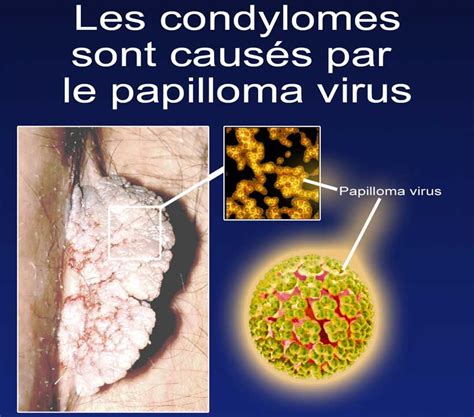 Les Infections Sexuellement Transmissibles Soigner Papillomavirus Chez