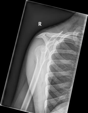 Shoulder Lateral Scapula View Radiology Reference Article Radiopaedia Org