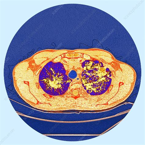 Pulmonary Sarcoidosis Ct Scan Stock Image C0372875 Science