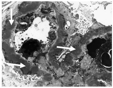 Stage 3 Membranous Glomerulonephritis With Medium Sized Subepithelial
