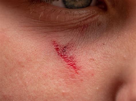 Red Scratch On The Face Stock Photo Image Of Blood 210272856